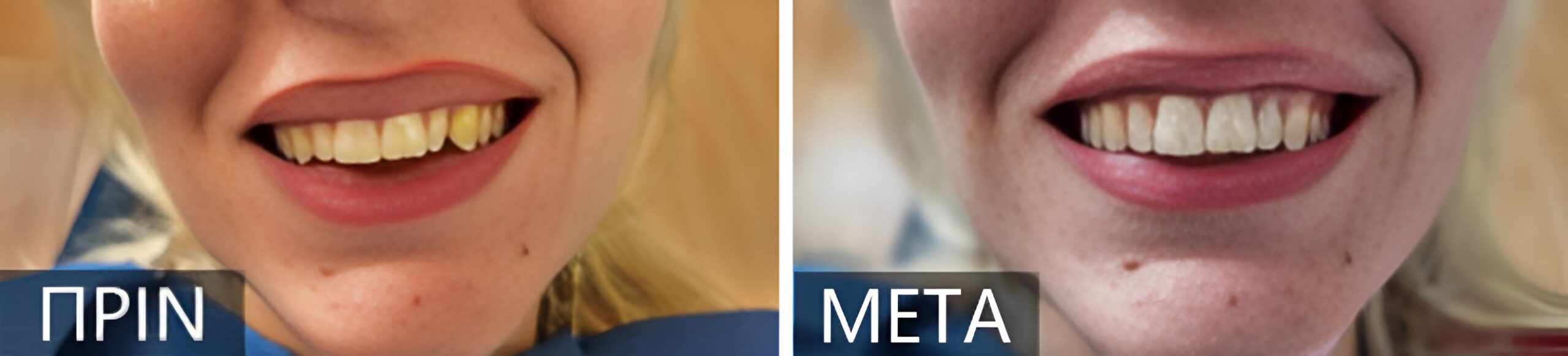 Before-and-after dental whitening: left side shows a smile with yellowed teeth labeled PRIN; right side shows a brighter, whiter smile labeled META.