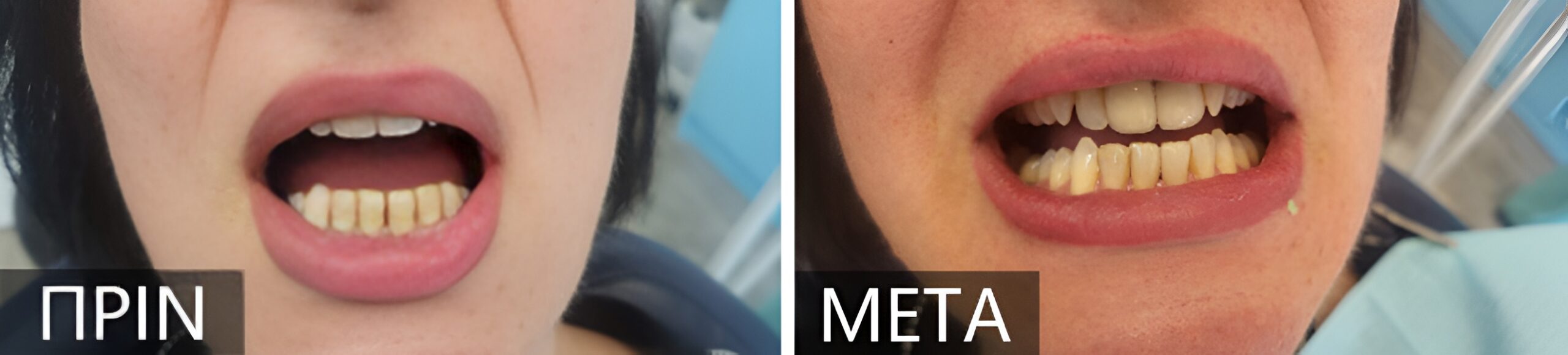 Side-by-side close-up of a wide-open mouth showing yellowed teeth on the left (before) and noticeably whiter teeth on the right (after).
