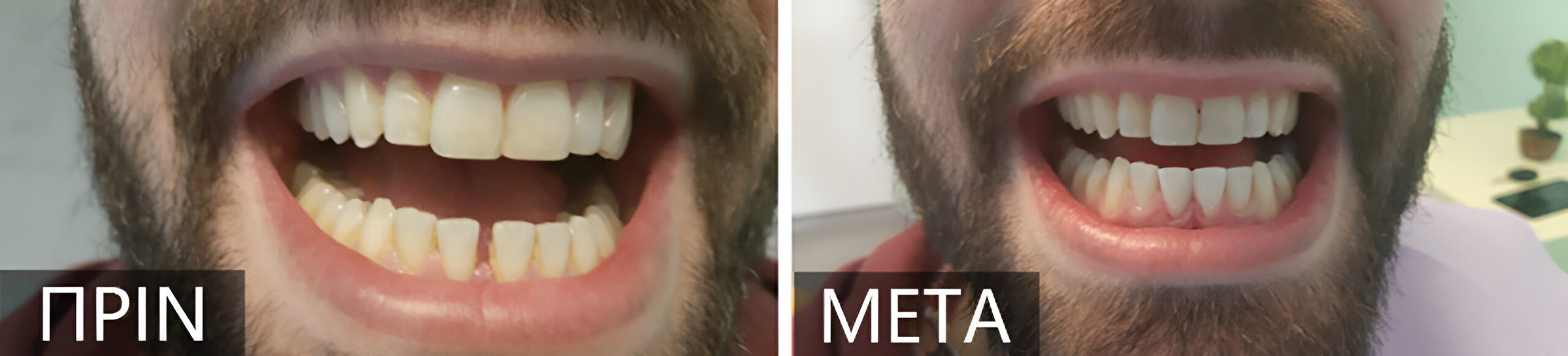 Side-by-side comparison of a man’s teeth: left shows yellowed teeth before whitening, right shows noticeably whiter teeth after treatment.