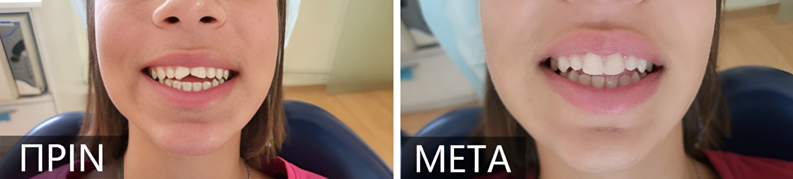 Two side-by-side photos of a woman smiling, labeled 'ΠΡΙΝ' (before) on the left and 'META' (after) on the right, showing dental improvement.