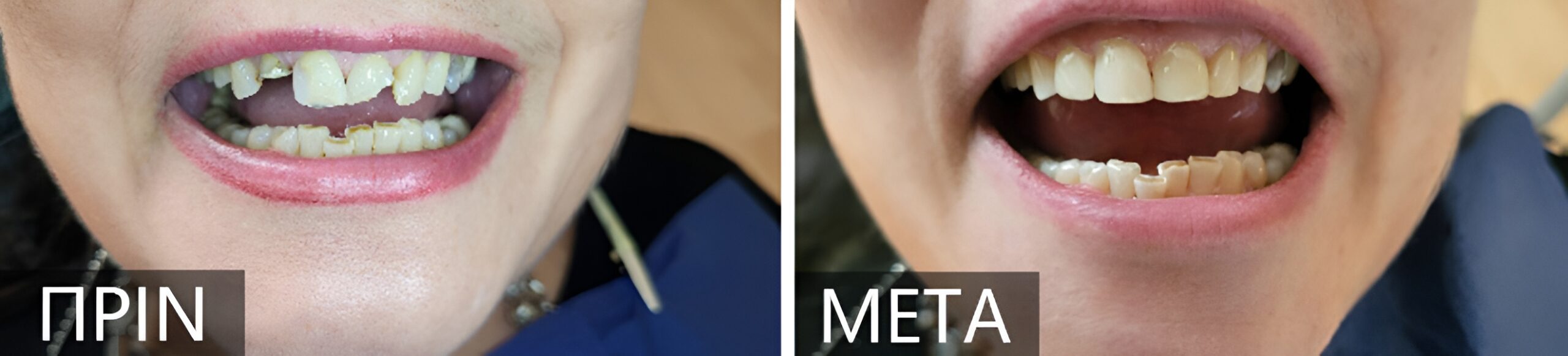 Before-and-after dental treatment: left panel shows damaged, chipped teeth with a missing front tooth; right panel shows a repaired, more even smile.