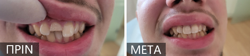 Before-and-after close-up of a mouth showing dental alignment changes; left image with protruding teeth, right image with improved alignment, captions say 'PRIN' and 'META'.