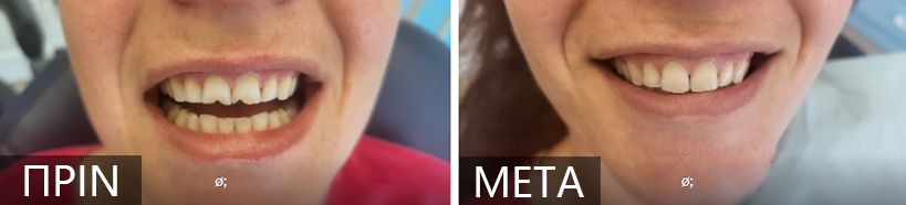 Before-and-after smile comparison: left panel shows a mouth with visible teeth labeled 'PRIN'; right panel shows a brighter, more even smile labeled 'META'.