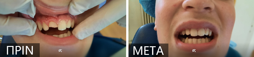 Before vs after orthodontic treatment: left panel shows a patient’s upper teeth with a gap; right panel shows improved alignment after treatment.