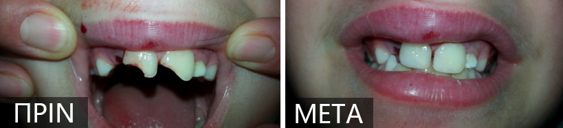 Before and after dental restoration: left panel shows damaged upper front teeth with gaps, right panel shows repaired, aligned teeth.