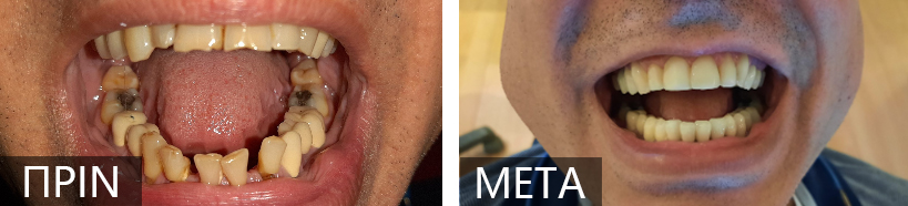 Side-by-side images of a mouth showing a before-and-after dental treatment: left panel with severely decayed, stained lower teeth; right panel with clean, white teeth and a wide smile; labels 'PRIN' and 'META' on the panels.