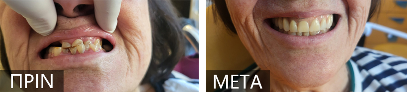 Side-by-side before-and-after of a patient’s teeth: left shows broken, missing teeth; right shows a restored, healthy smile after treatment