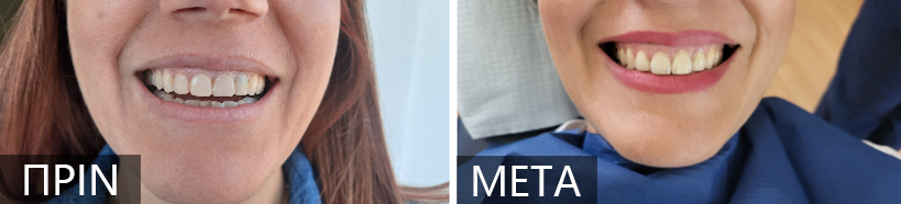 Split-screen close-up of two smiles: left shows a slightly stained smile labeled PRIN, right shows a whiter smile labeled META.