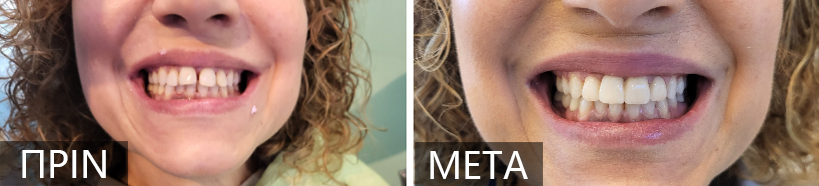 Side-by-side photos showing a smile before (left) and after whitening (right). Teeth appear whiter on the right image.