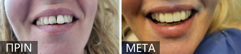 Two close-up smiles side by side, left labeled PRIN showing teeth before, right labeled META showing teeth after dental treatment with improved alignment and color.